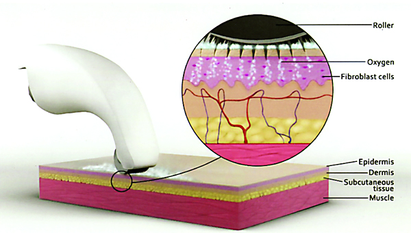 Microchannelling skin rejuvenation